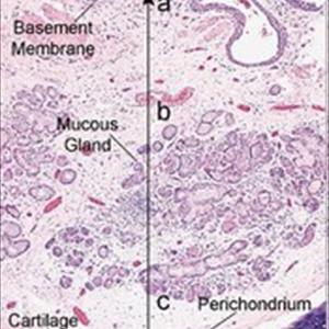 Medicine For Severe Bronchitis - Home Cures And Symptoms Regarding Bronchitis