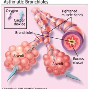 Bronchitis Cure - Bronchitis Herbal