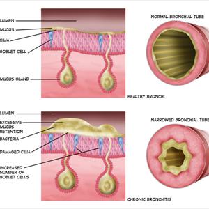 Bromovilcom - Why Holistic Cures Sometimes Fail