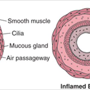 Wet Chesty Cough - Causes, Types And Medicines With Regard To COPD