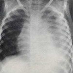 Bronchitis Cause - Deadly Diseases - Primarily Brought On By Excessive Cigarette Smoking