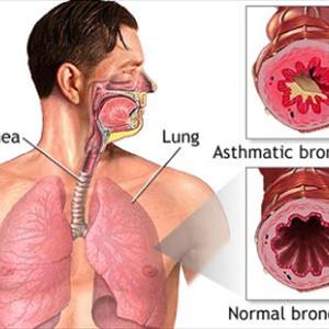 Alternative Cures For Bronchitis - Is Bronchitis Contagious? Yes And No