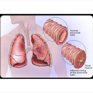 Silver Treatment To Cure Bronchitis - Bronchitis Pictures