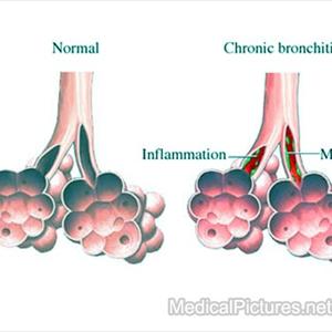 Bronovil Bronchitis Remedy - Cold Flu Treatment, Antibiotics, And Herbs