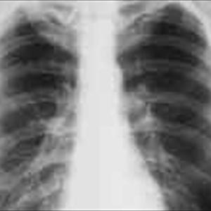 Natural Bronchi - An Breakdown Of Serious Asthmatic Bronchitis