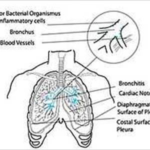 Bronchial Pain - Breast Biopsy