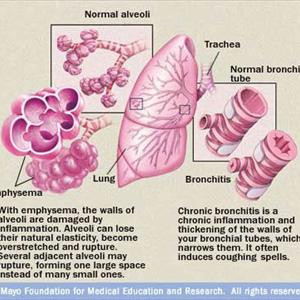Chronic Bronchitis Inhaler - Forms And Types Of Respiratory Disease