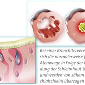 Homeopathic Medicine For Bronchitis - Lung Infections