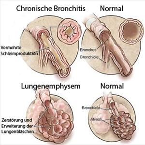 Bronovil Remedy - Acute Bronchitis