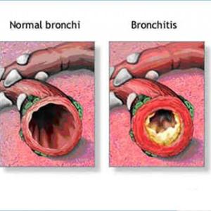 Bronchitis Antibiotics - Your Kids As Well As Bronchitis